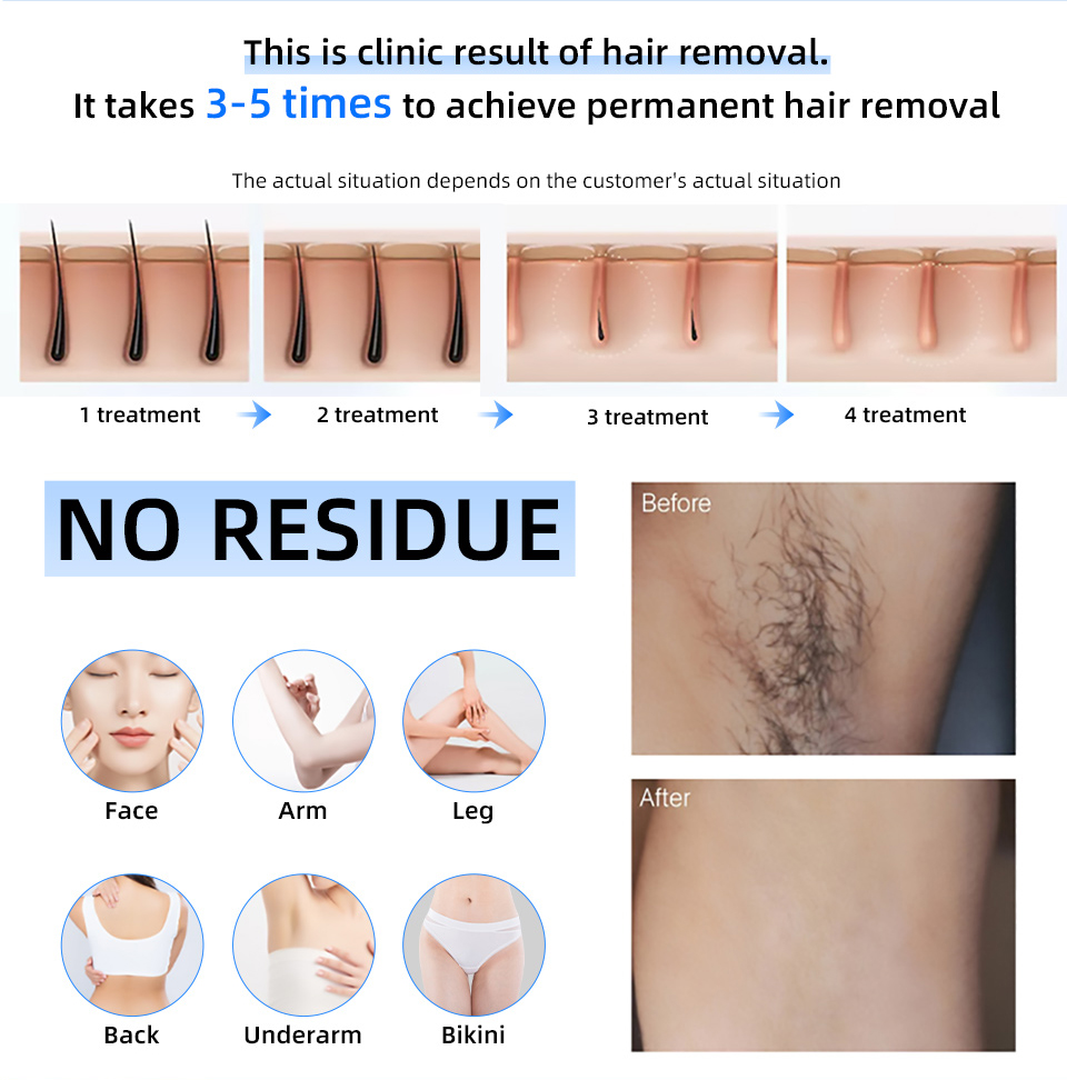 Factory Price 20000000 Beat 80 - Industrial Laser Hair Removal Machine recension och pris